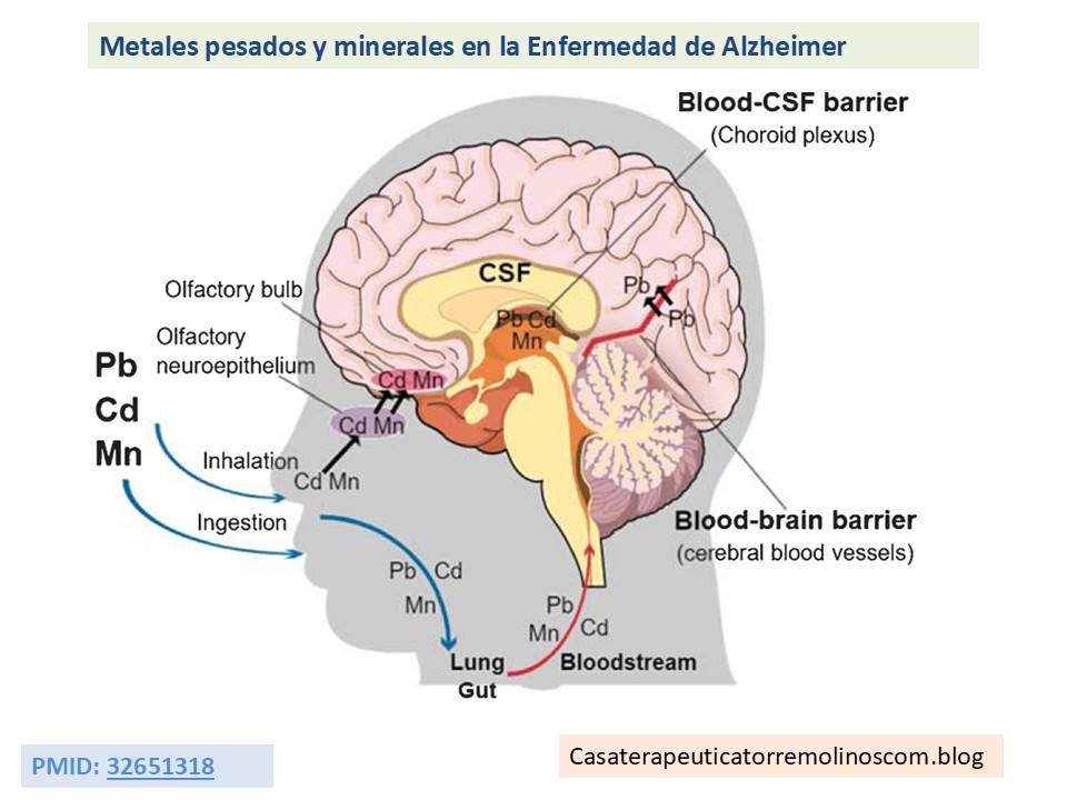 Enfermedad de Alzheimer